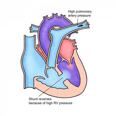 Eisenmenger syndrome