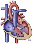 Eisenmenger syndrome