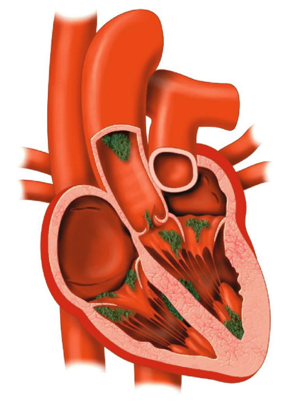 Endocarditis