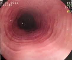 Eosinophilic esophagitis | Sweden| PDF | PPT| Case Reports ...