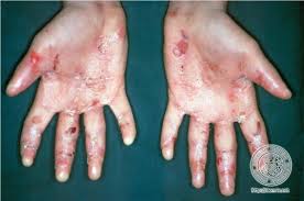 Epidermolysis bullosa