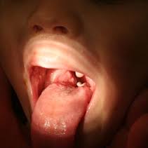 epiglottitis acute