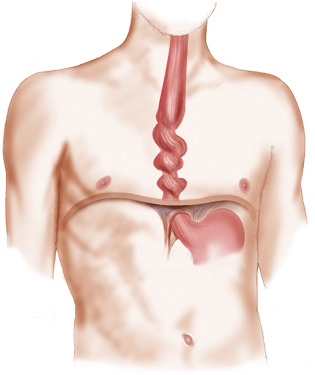 Esophageal Spasms | Brazil | PDF | PPT| Case Reports | Symptoms ...