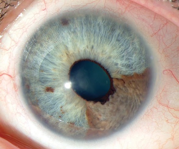 Eye Melanoma