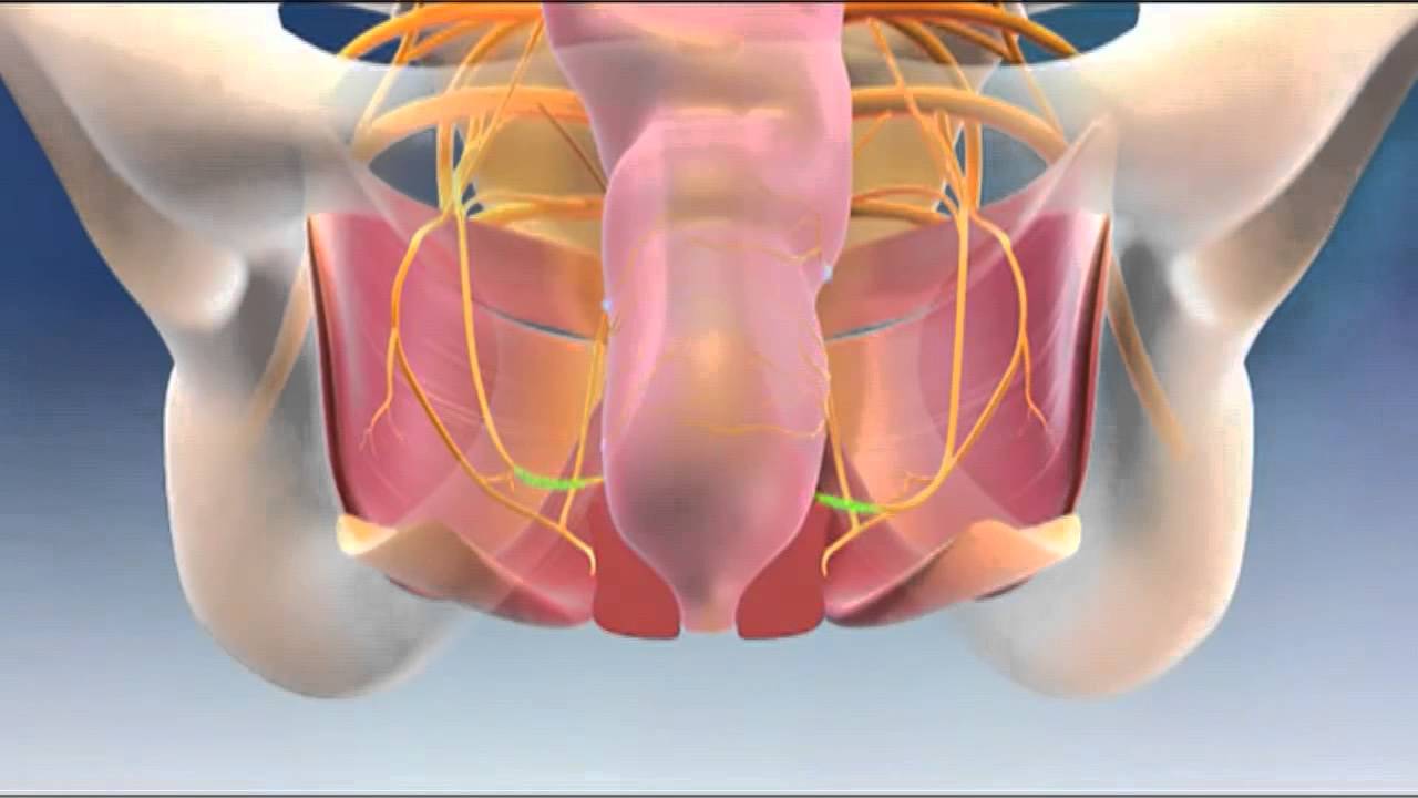 fecal incontinence