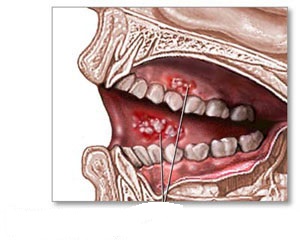 Floor Of The Mouth Cancer Japan Pdf Ppt Case Reports