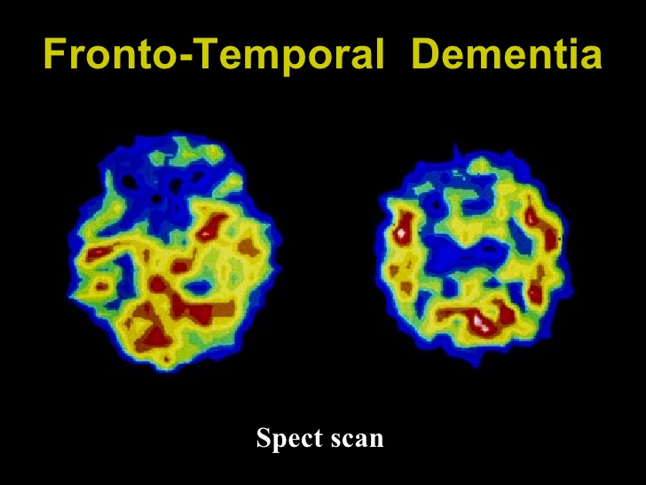 Frontotemporal Dementia 45590 