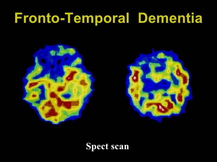 frontotemporal-dementia-belgium-pdf-ppt-case-reports-symptoms