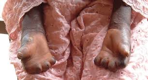 Hansens disease (HD)/ Leprosy | India| PDF | PPT| Case Reports