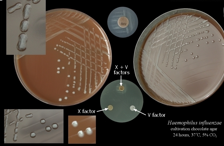 Hib Infection | Japan| PDF | PPT| Case Reports | Symptoms | Treatment