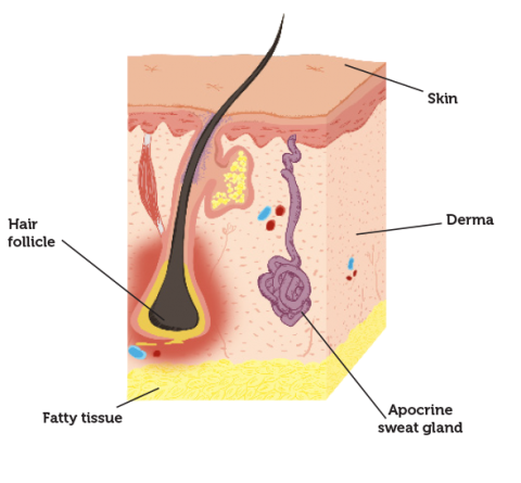 Hidradenitis suppurativa