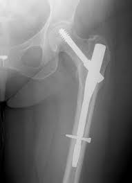 Hip fracture