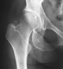 Hip fracture