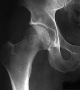 Hip Labral Tear X Ray