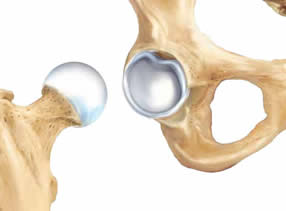 Hip labral tear