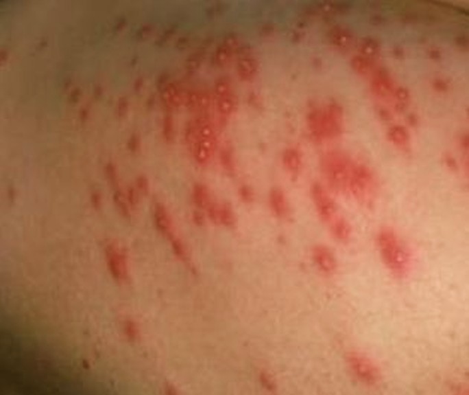 Hot Tub Rash Finland Pdf Ppt Case Reports Symptoms