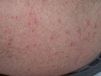 Hot Tub Rash | Italy| PDF | PPT| Case Reports | Symptoms | Treatment