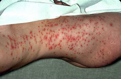 hot-tub-rash-united-states-pdf-ppt-case-reports-symptoms