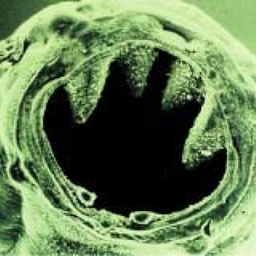 signs and symptoms of hookworms in humans