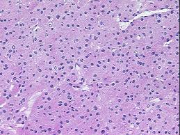 Hurthle cell Cancer