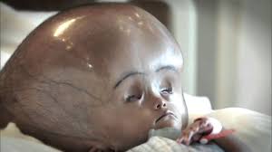 Neonatal Hydrocephalus