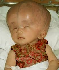 Hydrocephalus | Hong Kong| PDF | PPT| Case Reports | Symptoms | Treatment