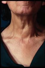 hyperparathyroidism symptoms checklist