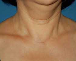 Hypoparathyroidism