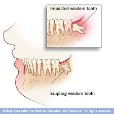 Impacted wisdom teeth