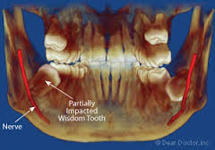 Impacted wisdom teeth