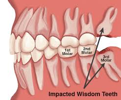 Impacted wisdom teeth