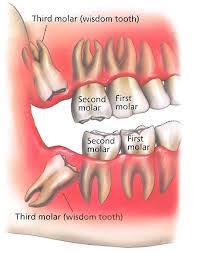 Impacted wisdom teeth | United States| PDF | PPT| Case ...