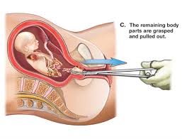 Incompetent Cervix Japan Pdf Ppt Case Reports Symptoms Treatment