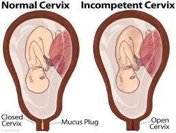 Incompetent Cervix Netherlands Pdf Ppt Case Reports Symptoms Treatment