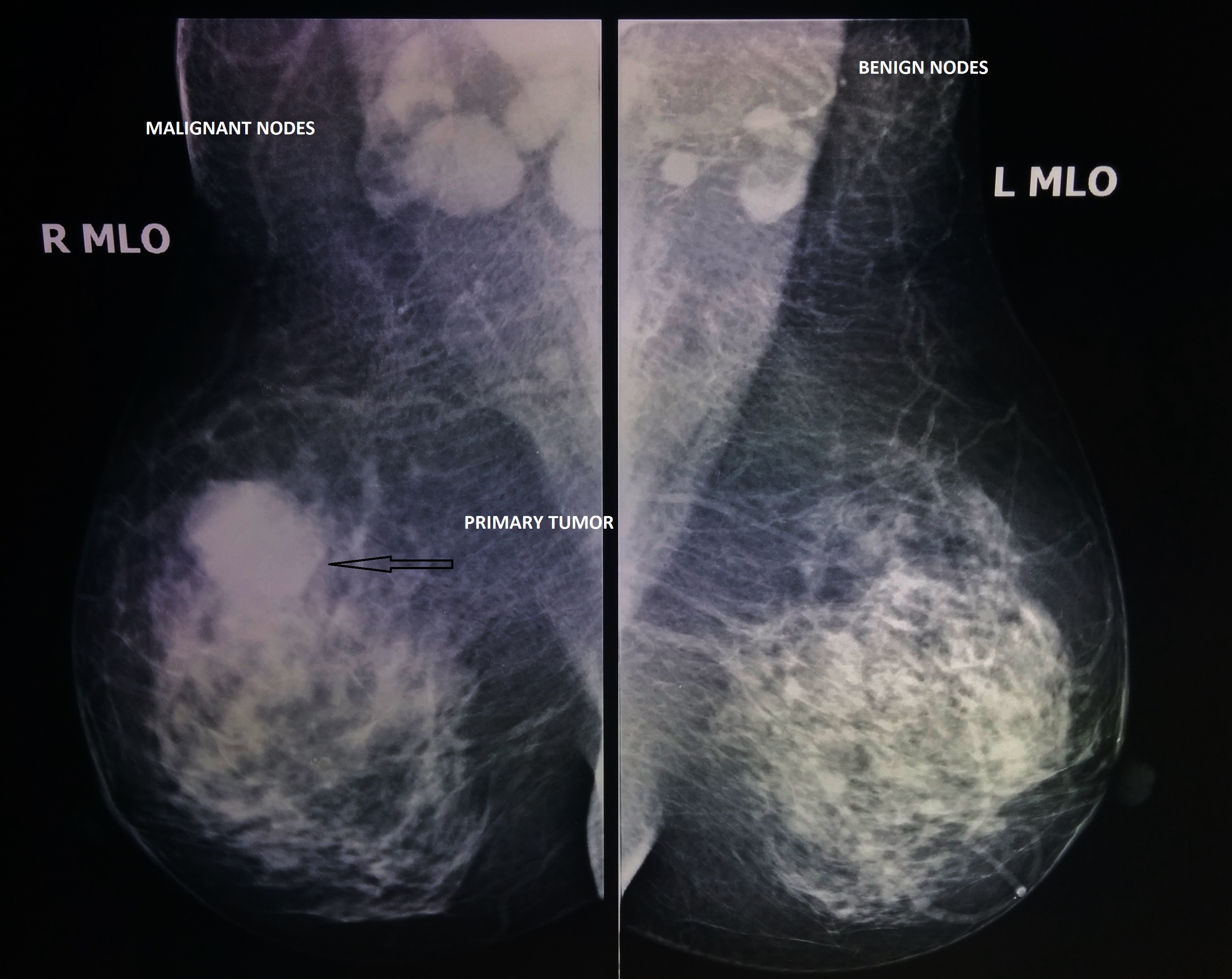 Inflammatory breast cancer | Poland| PDF | PPT| Case ...