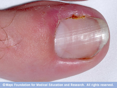 Ingrown Toenails | Spain| PDF | PPT| Case Reports | Symptoms | Treatment