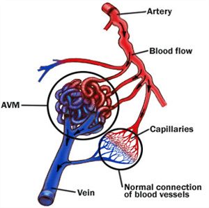 Intracranial venous malformations