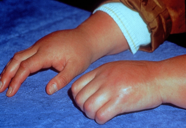 juvenile-rheumatoid-arthritis