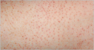 Keratosis pilaris | Mexico| PDF | PPT| Case Reports | Symptoms | Treatment