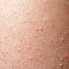 Keratosis pilaris | Mexico| PDF | PPT| Case Reports | Symptoms | Treatment