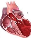 Left Ventricular Hypertrophy | Australia | PDF | PPT| Case Reports ...