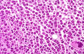 Leukemia | Finland| PDF | PPT| Case Reports | Symptoms | Treatment