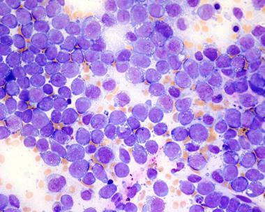 Leukemia