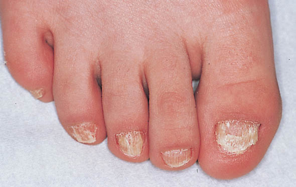 Lichen planus | France| PDF | PPT| Case Reports | Symptoms | Treatment