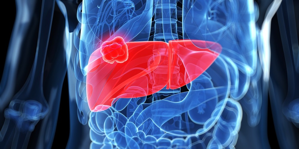 Liver cancer | Sweden| PDF | PPT| Case Reports | Symptoms | Treatment