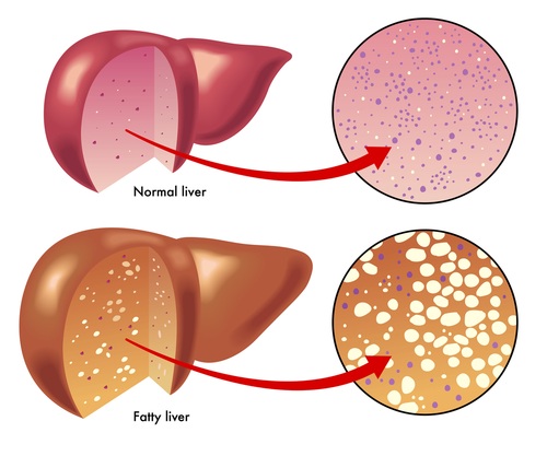 Metabolic syndrome