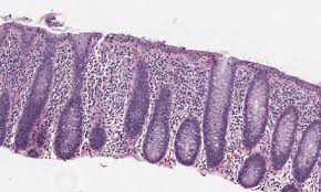 Microscopic colitis