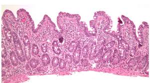 Microscopic colitis