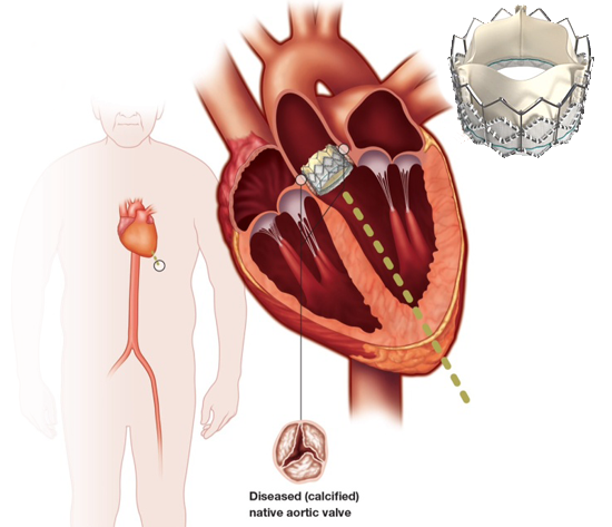 mitral-valve-regurgitation-causes-symptoms-and-treatment-excel