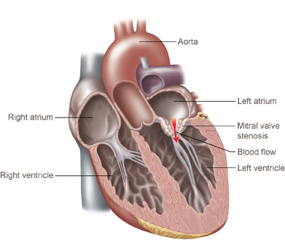 Mitral valve stenosis